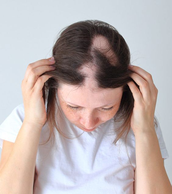 Hair loss diseased condition